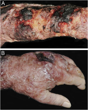 Criptococose cutânea primária. (A) Extensa lesão fagedênica e terebrante, com áreas necróticas e ulceradas, no braço, antebraço e dorso da mão. Paciente do sexo masculino, 80 anos. Corticoterapia 10mg. uso irregular por anos, por artrite. (B) Lesão eritemato‐edematosa, com vesículas e bolhas, área de necrose, dorso da mão (paciente referência #12).