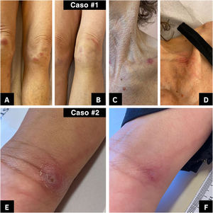 Dois casos de esporotricose transmitida por gato em pacientes com histórico de bypass gástrico em Y‐de‐Roux relatados no sul do Brasil. #Caso 1: (A e C) Lesões em membros inferiores e região cervical, respectivamente, no momento do diagnóstico (16/09/2022). (B e D) Lesões após 30 dias de tratamento (22/09/2022). #Caso 2: E, Lesão no momento do diagnóstico (27/06/2023). F, Lesão após 106 dias de tratamento (28/09/2023).