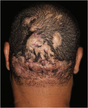 Celulite dissecante do couro cabeludo: lesões em estágio avançado apresentam múltiplos nódulos supurativos inflamatórios, abscessos e fístulas interconectadas com áreas de alopecia cicatricial.