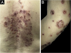 (A) Lesões cutâneas bolhosas com erosão e formação de crostas limitadas ao dorso de paciente adulto com dermatose bolhosa por IgA linear. (B) Lesões bolhosas arciformes com aparência de “aglomerado de joias” em paciente adulto com dermatose bolhosa por IgA linear.