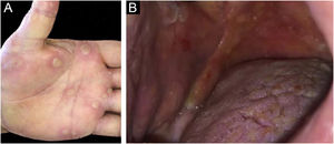 (A) Lesões vesiculobolhosas tensas na região palmar em paciente adulto com dermatose bolhosa por IgA linear. (B) Erosões e lesões bolhosas tensas na mucosa oral de paciente adulto com dermatose bolhosa por IgA linear.