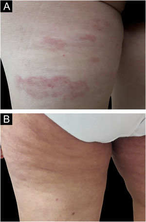 (A) Lesões em placas na coxa esquerda, face posterior, de paciente de 55 anos com micose fungoide estágio IA. (B) Resposta clínica completa na semana 16 de tratamento com bexaroteno.