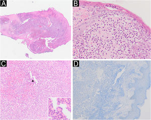 (A) Fragmento de pele de borda de úlcera exibindo denso infiltrado inflamatório neutrofílico (Hematoxilina & eosina, 4×). (B) Pústula subcórnea e abscesso neutrofílico na derme papilar (Hematoxilina & eosina, 40×). (C) Infiltrado inflamatório neutrofílico (Hematoxilina & eosina, 20×), com detalhe para célula gigante multinucleada (seta). (D) Imuno‐histoquímica negativa para Leishmania spp.