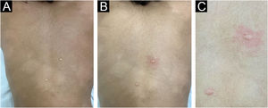 Teste de histamina em paciente com hanseníase. (A) Gota de histamina aplicada sobre lesão hipocrômica e sobre pele sã, em seguida realizadas puncturas pela histamina. (B) Presença de eritema reflexo em pele sã, não evidenciada na lesão de hanseníase. (C) Detalhe com pápula eritematosa em ambas puncturas, e eritema reflexo apenas na pele sã.