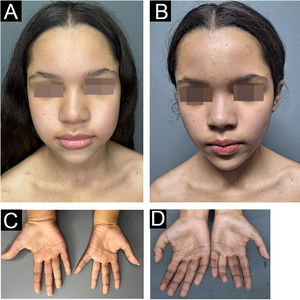 Paciente pré‐tratamento (A e C) e no dia do diagnóstico da meta‐hemoglobinemia (B e D) apresentando cianose central e de extremidades, associado a queixa de dispneia e fadiga.