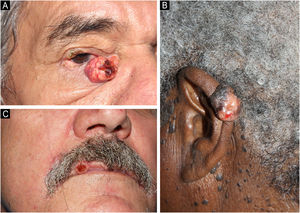 Fotos clínicas de carcinomas sebáceos. (A) Carcinoma sebáceo na pálpebra inferior. (B) Carcinoma sebáceo no pavilhão auricular. (C) Carcinoma sebáceo no lábio superior de paciente com SMT.