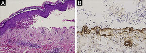 (A) Histopatologia da bolha de paciente com PB (Hematoxilina & eosina, 10×): bolha subepidérmica com infiltrado inflamatório eosinofílico. (B) Imuno‐histoquímica para colágeno IV em PB (20×). Observe a localização do colágeno IV (linha marrom) no assoalho da bolha. (C) Imuno‐histoquímica para colágeno IV realizada em paciente com EBA (10×). A positividade é observada no teto da bolha e em estruturas dérmicas que contêm colágeno IV, como as paredes vasculares.