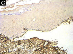 (A) Histopatologia da bolha de paciente com PB (Hematoxilina & eosina, 10×): bolha subepidérmica com infiltrado inflamatório eosinofílico. (B) Imuno‐histoquímica para colágeno IV em PB (20×). Observe a localização do colágeno IV (linha marrom) no assoalho da bolha. (C) Imuno‐histoquímica para colágeno IV realizada em paciente com EBA (10×). A positividade é observada no teto da bolha e em estruturas dérmicas que contêm colágeno IV, como as paredes vasculares.