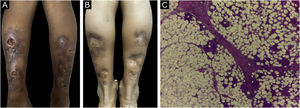 (A) Eritema indurado de Bazin – nódulos ulcerados, encimados por crosta serohemática e placa de atrofia, na região posterior das pernas. (B) Eritema indurado de Bazin – lesão pós‐tratamento. (C) Eritema indurado de Bazin – paniculite granulomatosa septal e lobular (Hematoxilina & eosina, 400×).