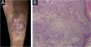 (A) Tuberculose verrucosa cútis – placa eritematovegetante com superfície verucosa e região central atrófica na região anterior de perna esquerda. (B) Tuberculose verrucosa cútis – epiderme hiperplasiada e derme mostrando granuloma epitelioide com célula gigante tipo Langhans (Hematoxilina & eosina, 100×).