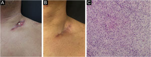 (A) Escrofuloderma – ulceração na região supraclavicular esquerda. (B) Escrofuloderma – lesão pós‐tratamento. (C) Escrofuloderma – granuloma epitelioide com necrose central e células gigantes multinucleadas do tipo Langhans (Hematoxilina & eosina, 200×).