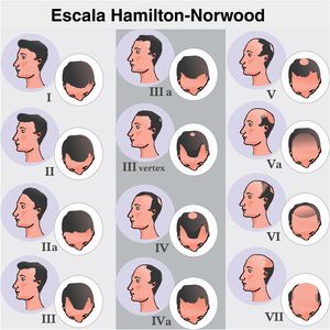 Classificação de Hamilton‐Norwood. Estágio I, sem perda de cabelo aparente ou mínima perda nas regiões temporais. Estágio II, leve recesso bitemporal, assumindo formato triangular simétrico. Estágio III, perda importante com pouca ou nenhuma cobertura capilar nas regiões temporais. Estágio III vértice, a perda capilar é mais pronunciada no vértice e o recesso na região temporal não excede aquele descrito no estágio III. Estágio IV, rarefação importante nas regiões temporais e no vértice, restando uma faixa densa de cabelos que separa as duas áreas. Estágio V, recuo da linha de implantação e rarefação mais evidente no vértice; a faixa de cabelos que separa as duas regiões apresenta densidade ainda mais reduzida, deixando menos evidente a área de transição. Estágio VI, regiões frontotemporal e vértice se unem pela perda completa da faixa de cabelos que as separava. Estágio VII, forma mais extensa de acometimento, restando apenas uma estreita faixa de cabelos nas regiões laterais e occipital.