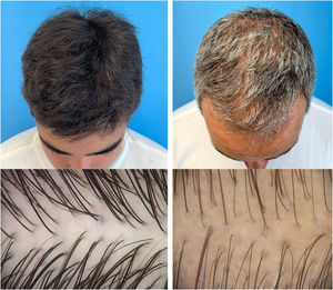 Comparação clínica e tricoscópica entre pai (direita) e filho (esquerda). As imagens destacam o processo de afinamento capilar e variabilidade folicular característicos da AAGM, como observado na imagem do pai (direita).