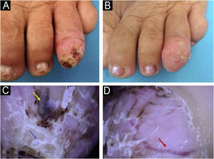 (A) Tumor ceratótico no quarto pododáctilo esquerdo. (B) Quatorze dias após foto A ‐ tumor em crescimento com afinamento mais evidente da lâmina ungueal e telangiectasias na superfície. C e D, Dermatoscopia, 10×. Presença de vasos lineares dilatados (seta vermelha), áreas amorfas acastanhadas (seta amarela) e placas brancas compactas (seta azul).