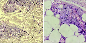 Histopatologia da vasculopatia livedoide. Proliferação de vasos na derme superficial e profunda, com espessamento da parede dos vasos. Pequenos focos de necrose e trombos pequenos nos vasos superficiais (Hematoxilina & eosina, 1.000×).