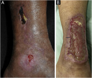 Úlceras isquêmicas hipertensivas. (A) Úlcera com leito necrótico e bordas purpúricas na face lateral da perna, e outra úlcera menor com leito com bom tecido de granulação no maléolo lateral. (B) Extensa úlcera na região posterior e de calcâneo, com leito desvitalizado e borda interna com sinal do batom‐vermelho (seta) e borda externa eritemato‐purpúrica.