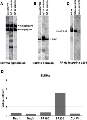 Resultados de immunoblotting e ELISA do soro da paciente. (A) O immunoblotting do extrato epidérmico mostrou autoanticorpos IgG e IgA positivos contra envoplaquina e periplaquina. (B) O immunoblotting do extrato dérmico mostrou autoanticorpos IgG e IgA positivos contra laminina (LM) γ1. (C) O immunoblotting da proteína recombinante (PR) da integrina α6β4 mostrou autoanticorpos IgG positivos contra a integrina α6. A PR da integrina α6β4 foi adquirida de R&D systems (Minneapolis, MN, EUA). mAb, anticorpo monoclonal para integrina α6 (Beyotime, Xangai, China). (D) Detecção de autoanticorpos IgG contra desmogleína (Dsg) 1, Dsg3, BP180, BP230 e colágeno tipo VII por ELISA utilizando kit disponível comercialmente (MBL, Japão). Apenas os autoanticorpos anti‐BP230 foram positivos. As linhas pontilhadas indicam o valor de corte.