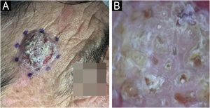 (A) Placa hiperceratótica bem delimitada com superfície erosada. (B) A dermatoscopia revela fundo branco com escamas superficiais, múltiplos óstios foliculares preenchidos por queratina (seta), círculos perifoliculares brancos circundados por eritema (seta 2) e áreas brancas sem estrutura (seta 3). Algumas áreas vermelhas atribuíveis a sangramento e/ou vascularização densa são vistas na periferia.