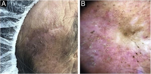 (A) Recorrência. Placa descamativa sobre a cicatriz anterior. (B) A dermatoscopia mostra fundo vermelho leitoso com pseudo‐rede entre os óstios foliculares preenchidos por queratina em formato de alvo (seta). Pigmentação irregular das aberturas foliculares (seta 2) e algumas áreas brancas sem estrutura também são vistas (seta 3).