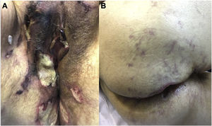 (A) Múltiplas úlceras profundas com crostas necróticas e fibrina na área vulvar. (B) Lesões livedoides região glútea.