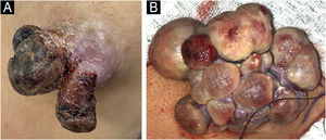 (A) Imagem clínica de tumor exofítico primário localizado no cotovelo esquerdo, com crosta hemorrágica na superfície com um mês de evolução. (B) Imagem clínica mostrando aspecto multilobulado do tumor primário após quatro meses de rápido crescimento.