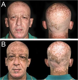 (A) Hiperpigmentação de máculas de vitiligo na área periorbital e couro cabeludo, que começou dois meses após o início do metimazol (novembro de 2020). (B) Cinco meses após o início do metimazol, múltiplas máculas e manchas marrons bem demarcadas e dispersas foram observadas em áreas expostas ao sol nos pavilhões auriculares, região frontal, regiões periorbitais e couro cabeludo (fevereiro de 2021).