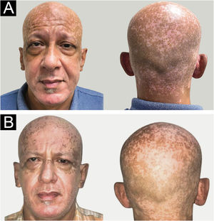 (A) Seis meses após o início do metimazol, presença de hiperpigmentação difusa acastanhada em toda a região cefálica (março de 2021). (B) Oito meses após a mudança para propiltiouracil, em associação ao uso de protetor solar e chapéu, observa‐se clareamento significante das manchas hiperpigmentadas da face (outubro de 2021).