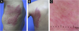 (A–B) Nódulos e placas eritematosas distribuídas em padrão zosteriforme na parede torácica esquerda, contralateral ao tumor primário. (C) Dermatoscopia de metástases cutâneas zosteriformes. Vasos lineares, irregulares e polimórficos com áreas eritematosas sem estrutura de fundo.