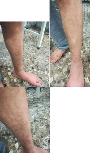 Visible mass standing and straining the leg muscles approximately 2cm, seen along the anterior aspect of the leg in its mid-part.