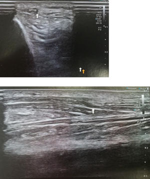 Dynamic ultrasound with patient standing confirming herniation of the anterior tibial muscle with partial disruption of its fascia, a hernia of 11.7mm in size with a 3-cm extension (screws).
