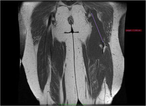 MRI demonstrating proximal avulsion of the hamstring tendon with an approximate retraction of 11cm.