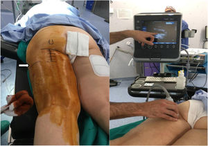 (a, b) Surgical incision. Note the ultrasound marking of the retraction level of the stump (white arrow).