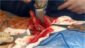Release of the stump. The sciatic nerve is seen attached to the myotendinous junction (star).