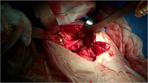 Insertional footprint. The release of the stump allows sufficient mobilization for its anatomical reanchoring in the ischial footprint, previously debrided (star).