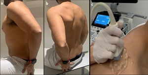 Photograph showing example scanning position and plane for shear wave acquisition. (a,b) The sitting position is shown, with the arm in the Crass position. The arm posteriorly placing the palmar side of the hand on the superior aspect of the iliac wig with the elbow flexed (internal rotation). (c) The probe position is shown longitudinal orientation relative to the supraspinatus muscle. During data acquisition, an amount of gel (5 mm) and minimal contact pressure were applied to minimize the longitudinal preload.