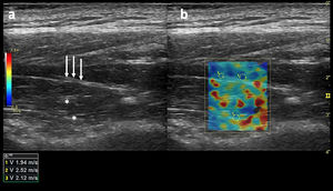 (a) Long-axis grayscale US image of the supraspinatus muscle belly. Central tendon (long arrows) and pennate pattern are visible. There is mildly increased echogenicity relative to normal background muscle (asterisks). (b) SWE image (color elastogram) of the same region shows predominantly intermediate shear-wave velocity on anterior (1), posterior (2) and myotendinous junction (3,1.94 m/sec, 2.52 m/sec, 2.12 m/sec, respectively). Red = hard consistency (7.1 m/sec), blue = soft consistency (0.0 m/sec), and green and yellow = intermediate consistency. SWE data were collected using a Logiq S8 R4 (General Electric, United States) with an L9–15-MHz linear transducer.