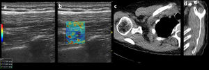 Images of a 45-year-old male patient. (a) Long-axis grayscale US image of supraspinatus muscle belly with increased echogenicity relative to normal background muscle. (b) SWE image (color elastogram) of the same region shows predominatly low intermediate shear-wave velocity on anterior (1), posterior (2) and myotendinous juction (3,2.29 m/sec, 3.69 m/sec, 2.11 m/sec, respectively). Red = hard consistency (7.1 m/sec), blue = soft consistency (0.0 m/sec), and green and yellow = intermediate consistency. SWE data were collected using an Logiq S8 R4 (General Electric, United States) with a L9–15-MHz linear transducer. (c) Axial CT shoulder image used to quantify the amount of fatty degeneration of the supraspinatus shows degeneration of some fatty streaks within supraspinatus (Goutallier grade II). (d) Sagittal oblique CT image shows supraspinatus with moderate atrophy and fatty degeneration (Goutallier grade II).