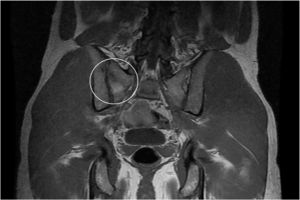 Magnetic resonance, coronal view. Bone oedema can be seen at the sacroiliac joint with a small fracture on the oblique sacral body (White circle).