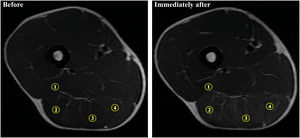 Selected magnetic resonance images acquired before and immediately after the Flywheel Russian belt deadlift training session, depicting regions of interest (ROIs). 1, m. biceps femoris short head (BFSH); 2, m. biceps femoris long head (BFLH); 3, m. semitendinosus (ST); 4, m. semimembranosus (SM).