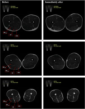 Representative T2-weighted magnetic resonance images of the proximal region (25 % of thigh length), middle region (50 % of thigh length) and distal region (75 % of the tight length) before and immediately after the Flywheel Russian belt deadlift training session. BFSH, m. biceps femoris short head; BFLH, m. biceps femoris long head; ST, m. semitendinosus; SM, m. semimembranosus.
