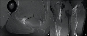 MRI Hockey player. Axial (A) and coronal (B and C) proton density fat saturated images. In the axial view there is a complete transversal rupture of the proximal tendon of the long head of biceps femoris (arrowhead), in the coronal view (B) is shown the rupture (arrowhead) with proximal destructuring of the free tendon (thicker and hyperintensity) (arrow). In the more posterior coronal view (C), there is retraction of the distal portion of the rupture (arrowhead) with lost of tendon tension and lost of pennation angle.
