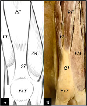 A Thigh anatomical model. B. Thigh anatomical dissection. VM (vastus medialis), VL (vastus lateralis), RF (rectus femoris), QT (quadricipital tendon), PAT (patella).