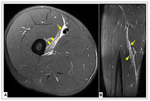 Case 1. Distal myofascial injury 2A (BAMIC) in the VM. A Axial T2 Fat-sat section. B Coronal T2 Fat-sat section. Arrowheads (Interstitial edema in the VM), Arrow (hematoma Hunter