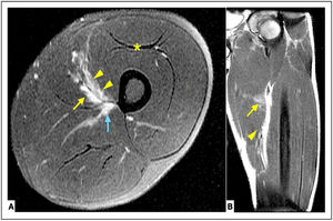 Case 3. Distal myofascial injury 2A (BAMIC) in the VM. A Axial T2 Fat-sat section. B Coronal T2 Fat-sat section. Arrowheads (Interstitial edema in the VM), Yellow arrow (Edema in the AL), Blue arrow (Edema in the AM), Asterisk (Old scar Posterior Ap. RF, relevant to the discussion). The interstitial edema in the VM is similar to case 1, additionally, it extends within the adductor longus (AL) and adductor magnus (AM) with evidence of both damages.
