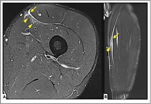Case 4. Proximal myofascial injury 2A (BAMIC) in the VM. A Axial T2 Fat- sat section. B Coronal T2 Fat-sat section. Arrowheads (Interstitial edema in the VM), Arrow (hematic collection in relation to posterior fascia RF injury). In this case the damage is located in the proximal MFJ of the VM, in relation to an acute injury of RF posterior fascia, that by extension, reaches the most anterior fibers of the VM.