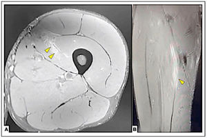 Case 2. Distal myotendinous injury 1B (BAMIC) in the VM. A Axial T2 Fat-sat section. B Coronal T2 Fat-sat section. Arrowheads (Edema in the insertional aponeurosis of the VM in the VI). This is the only myotendinous injury in this series, it affects the distal MTJ, at the insertion tract of the VM into the VI.