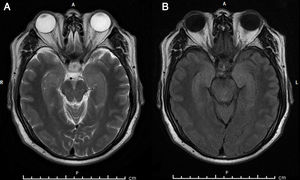 La resonancia magnética cerebral muestra, en T2 (a) y FLAIR (b) axial, hiperintensidades a nivel temporal mesial bilateral de predominio derecho.