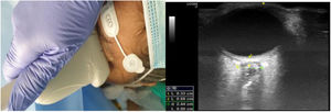 Colocación de sonda lineal e imagen del globo ocular e imagen ecográfica del globo ocular. El estudio ecográfico se realizaba con aparato de ultrasonidos en modo-B, fijando unos parámetros de índice térmico menor de 1 e índice térmico menor de 0,2. El foco se situaba 1-2 cm por debajo del objetivo (origen del nervio óptico en el globo ocular).