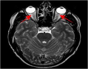 RM cerebral T2 sin contraste. En este corte axial a nivel de las órbitas se visualiza el trayecto completo de ambos nervios ópticos, destacando una hiperseñal bilateral de los 2 en su parte más anterior.