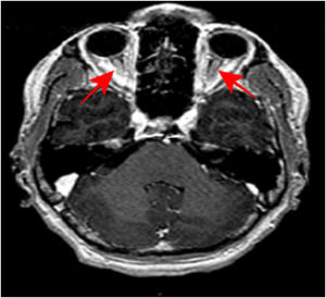 RM cerebral 3DT1 tras la administración del contraste intravenoso. En este corte axial, comparándolo con el previo, se objetiva hipercaptación de contraste por parte de ambos nervios ópticos, hallazgo muy sugestivo de neuritis óptica bilateral.